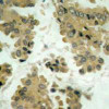 Immunohistochemical analysis of paraffin-embedded human lung carcinoma tissue using Akt2 (Ab-474) .