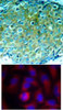 <b>Top Image:</b> Immunohistochemical analysis of paraffin-embedded human breast carcinoma tissue using PAK1 (Ab-212) .<b>Bottom Image:</b> Immunofluorescence staining of methanol-fixed HeLa cells using PAK1 (Ab-212) .