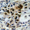 Immunohistochemical analysis of paraffin-embedded human lung carcinoma tissue using AFX (Ab-197) .