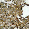 Immunohistochemical analysis of paraffin-embedded human breast carcinoma tissue using cofilin (Ab-3) .