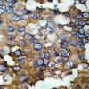 Immunohistochemical analysis of paraffin-embedded human breast carcinoma tissue using Src (Ab-529) .
