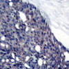 Immunohistochemical analysis of paraffin-embedded human breast carcinoma tissue using IkappaB-&#945; (Ab-42) .