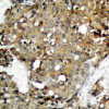Immunohistochemical analysis of paraffin-embedded human breast carcinoma tissue using STAT1 (Ab-727) .