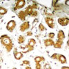 Immunohistochemical analysis of paraffin-embedded human breast carcinoma tissue using NF&#954;B-p65 (Ab-505) .