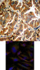 <b>Top Image:</b> Immunohistochemical analysis of paraffin-embedded human lung carcinoma tissue using ADD1 (Ab-726) .<b>Bottom Image:</b> Immunofluorescence staining of methanol-fixed HeLa cells using ADD1 (Ab-726) .
