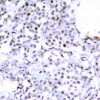Immunohistochemical analysis of paraffin-embedded human breast carcinoma tissue using SMC1 (Ab-957) .