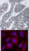 <b>Top Image:</b> Immunohistochemical analysis of paraffin-embedded human breast carcinoma tissue using Pyk2 (Ab-402) .<b>Bottom Image:</b> Immunofluorescence staining of methanol-fixed HeLa cells using Pyk2 (Ab-402) .
