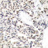 Immunohistochemical analysis of paraffin-embedded human breast carcinoma tissue using NF&#954;B-p65 (Ab-529) .
