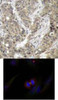 <b>Top Image:</b> Immunohistochemical analysis of paraffin-embedded human breast carcinoma tissue using &#946;-Catenin (Ab-37) .<b>Bottom Image:</b> Immunofluorescence staining of methanol-fixed HeLa cells using &#946;-Catenin (Ab-37) .