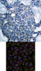 <b>Top Image:</b> Immunohistochemical analysis of paraffin-embedded human breast carcinoma tissue using Stathmin 1 (Ab-25) .<b>Bottom Image:</b> Immunofluorescence staining of methanol-fixed HeLa cells using Stathmin 1 (Ab-25) .