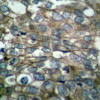 Immunohistochemical analysis of paraffin-embedded human breast carcinoma tissue using EGFR (Ab-869) .