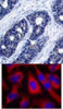 <b>Top Image:</b> Immunohistochemical analysis of paraffin-embedded human breast carcinoma tissue using IRS-1 (Ab-636) .<b>Bottom Image:</b> Immunofluorescence staining of methanol-fixed HeLa cells using IRS-1 (Ab-636) .