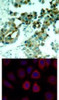 <b>Top Image:</b> Immunohistochemical analysis of paraffin- embedded human lung carcinoma tissue using S6 Ribosomal Protein (Ab-235) .<b>Bottom Image:</b> Immunofluorescence staining of methanol-fixed MCF7 cells using S6 Ribosomal Protein (Ab-235) .