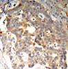 Immunohistochemical analysis of paraffin-embedded human breast carcinoma tissue using SAPK/JNK (Ab-183) .