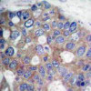 Immunohistochemical analysis of paraffin-embedded human breast carcinoma tissue using p70 S6 Kinase (Ab-421) .