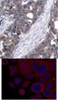 <b>Top Image:</b> Immunohistochemical analysis of paraffin-embedded human breast carcinoma tissue using p70 S6 Kinase (Ab-411) .<b>Bottom Image:</b> Immunofluorescence staining of methanol-fixed MCF7 cells using p70 S6 Kinase (Ab-411) .