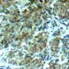 Immunohistochemical analysis of paraffin-embedded human breast carcinoma tissue using Cortactin (Ab-466) .
