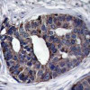 Immunohistochemical analysis of paraffin-embedded human breast carcinoma tissue using p62Dok (Ab-362) .
