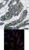 <b>Top Image:</b> Immunohistochemical analysis of paraffin-embedded human breast carcinoma tissue using p62Dok (Ab-398) .<b>Bottom Image:</b> Immunofluorescence staining of methanol-fixed HeLa cells using p62Dok (Ab-398) .