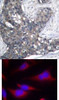 <b>Top Image:</b> Immunohistochemical analysis of paraffin-embedded human breast carcinoma tissue using eIF2&#945; (Ab-51) .<b>Bottom Image:</b> Immunofluorescence staining of methanol-fixed HeLa cells using eIF2&#945; (Ab-51) .