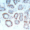 Immunohistochemical analysis of paraffin-embedded human breast carcinoma tissue using BIM (Ab-69) .