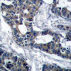 Immunohistochemical analysis of paraffin-embedded human breast carcinoma tissue using MEK1 (Ab-291) .