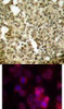 <b>Top Image:</b> Immunohistochemical analysis of paraffin-embedded human breast carcinoma tissue using PKC&#948; (Ab-645) .<b>Bottom Image:</b> Immunofluorescence staining of methanol-fixed HeLa cells using PKC&#948; (Ab-645) .