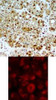<b>Top Image:</b> Immunohistochemical analysis of paraffin-embedded human breast carcinoma tissue using HSP90B (Ab-254) .<b>Bottom Image:</b> Immunofluorescence staining of methanol-fixed HeLa cells showing cytoplasmic staining using HSP90B (Ab-254) .