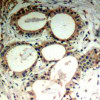 Immunohistochemical analysis of paraffin-embedded human breast carcinoma tissue using IkappaB-&#949; (Ab-22) .