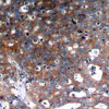 Immunohistochemical analysis of paraffin-embedded human breast carcinoma tissue using IGF-1R (Ab-1346) .