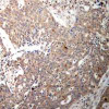 Immunohistochemical analysis of paraffin-embedded human breast carcinoma tissue using Keratin 18 (Ab-33) .
