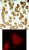 <b>Top Image:</b> Immunohistochemical analysis of paraffin-embedded human breast carcinoma tissue using Keratin 8 (Ab-74) .<b>Bottom Image:</b> Immunofluorescence staining of methanol-fixed HeLa cells using Keratin 8 (Ab-74) .