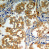 Immunohistochemical analysis of paraffin-embedded human lung carcinoma tissue using PKCzeta (Ab-410) .