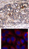<b>Top Image:</b> Immunohistochemical analysis of paraffin-embedded human breast carcinoma tissue using Shc1 (Ab-427) .<b>Bottom Image:</b> Immunofluorescence staining of methanol-fixed HeLa cells using Shc1 (Ab-427) .