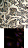 <b>Top Image:</b> Immunohistochemical analysis of paraffin-embedded human breast carcinoma tissue using coflin1/cofilin2 (Ab-88) .<b>Bottom Image:</b> Immunofluorescence staining of methanol-fixed HeLa cells using coflin1/cofilin2 (Ab-88) .