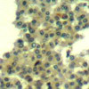 Immunohistochemical analysis of paraffin-embedded human breast carcinoma tissue using Her3/ErbB3 (Ab-1328) .