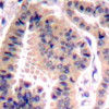 Immunohistochemical analysis of paraffin-embedded human lung carcinoma tissue using eIF4B (Ab-422) .