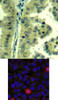 <b>Top Image:</b> Immunohistochemical analysis of paraffin-embedded human lung carcinoma tissue using eIF4G (Ab-1232) .<b>Bottom Image:</b> Immunofluorescence staining of methanol-fixed HeLa cells using eIF4G (Ab-1232) .