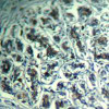 Immunohistochemical analysis of paraffin-embedded human breast carcinoma tissue using PLC-&#947;1 (Ab-771) .