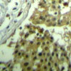 Immunohistochemical analysis of paraffin-embedded human breast carcinoma tissue using CDC2 (Ab-19) .