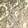 Immunohistochemical analysis of paraffin-embedded human lung carcinoma tissue using STAT2 (Ab-690) .