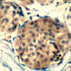 Immunohistochemical analysis of paraffin-embedded human breast carcinoma tissue using c-kit (Ab-936) .
