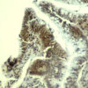 Immunohistochemical analysis of paraffin-embedded human colon carcinoma tissue using CDK6 (Ab-13) .