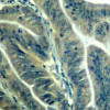 Immunohistochemical analysis of paraffin-embedded human colon carcinoma tissue using CDK6 (Ab-24) .