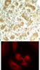 <b>Top Image:</b> Immunohistochemical analysis of paraffin-embedded human breast carcinoma tissue using syk (Ab-323) .<b>Bottom Image:</b> Immunofluorescence staining of methanol-fixed HeLa cells using syk (Ab-323) .