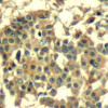 Immunohistochemical analysis of paraffin-embedded human breast carcinoma tissue using Met (Ab-1003) .