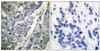 Immunohistochemical analysis of paraffin-embedded human breast carcinoma tissue using Synaptotagmin (phospho-Thr202) antibody (left) or the same antibody preincubated with blocking peptide (right) .