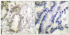 Immunohistochemical analysis of paraffin-embedded human colon carcinoma tissue using C/EBP-alpha (phospho-Ser21) antibody (left) or the same antibody preincubated with blocking peptide (right) .