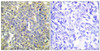 Immunohistochemical analysis of paraffin-embedded human lung carcinoma tissue using Caspase 9 (Phospho-Thr125) antibody (left) or the same antibody preincubated with blocking peptide (right) .