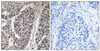Immunohistochemical analysis of paraffin-embedded human breast carcinoma tissue, using p130 Cas (Phospho-Tyr410) antibody (left) or the same antibody preincubated with blocking peptide (right) .